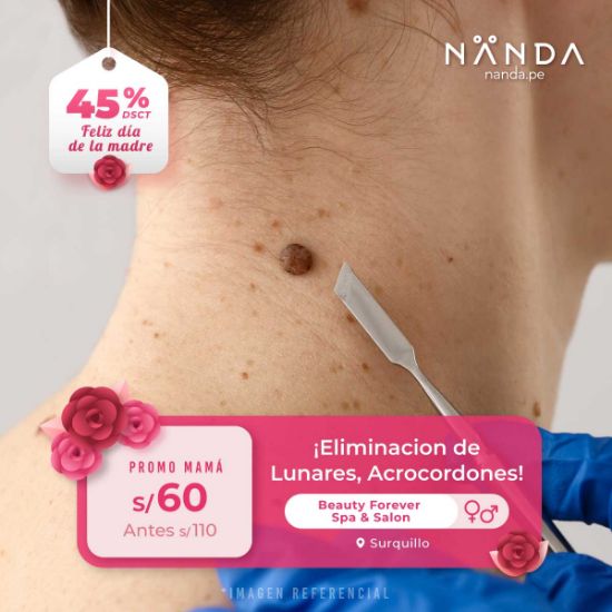 ¡Eliminación de Lunares, Acrocordones! 😍   - Beauty Forever Spa & Salon (SURQUILLO)