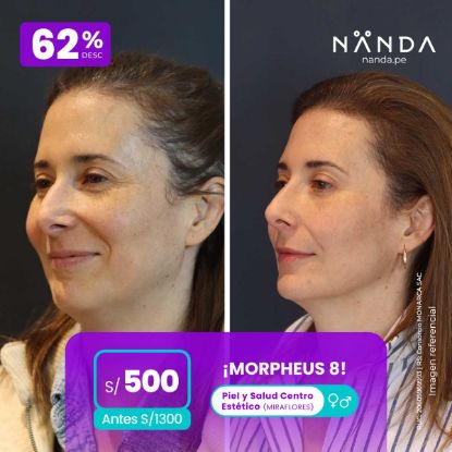 ¡MORPHEUS 8! 😍 - Piel y Salud Centro Estético (MIRAFLORES) 