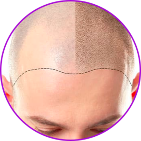 Imagen para la categoría Tricopigmentación o Micropigmentación Capilar