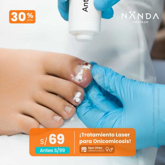 ¡Tratamiento Laser para Onicomicosis! 😍 - Spa Uñas (MIRAFLORES)