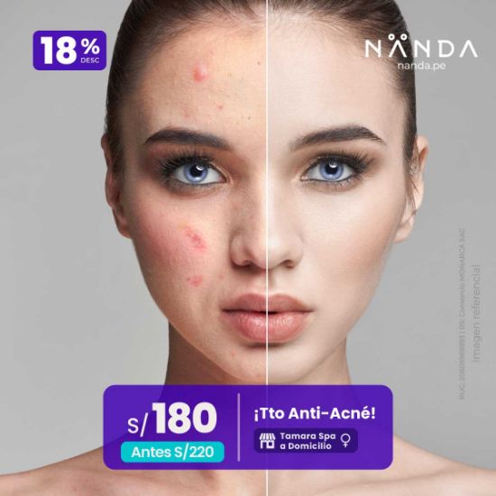 ¡Tto Anti-Acné x Sesión! 😍 - Tamara Spa (a Domicilio)