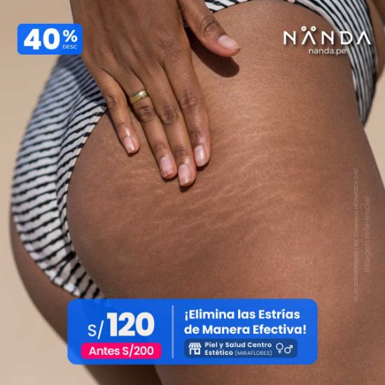 ¡Elimina las Estrías de Manera Efectiva! 😍 - Piel y Salud Centro Estético (MIRAFLORES)